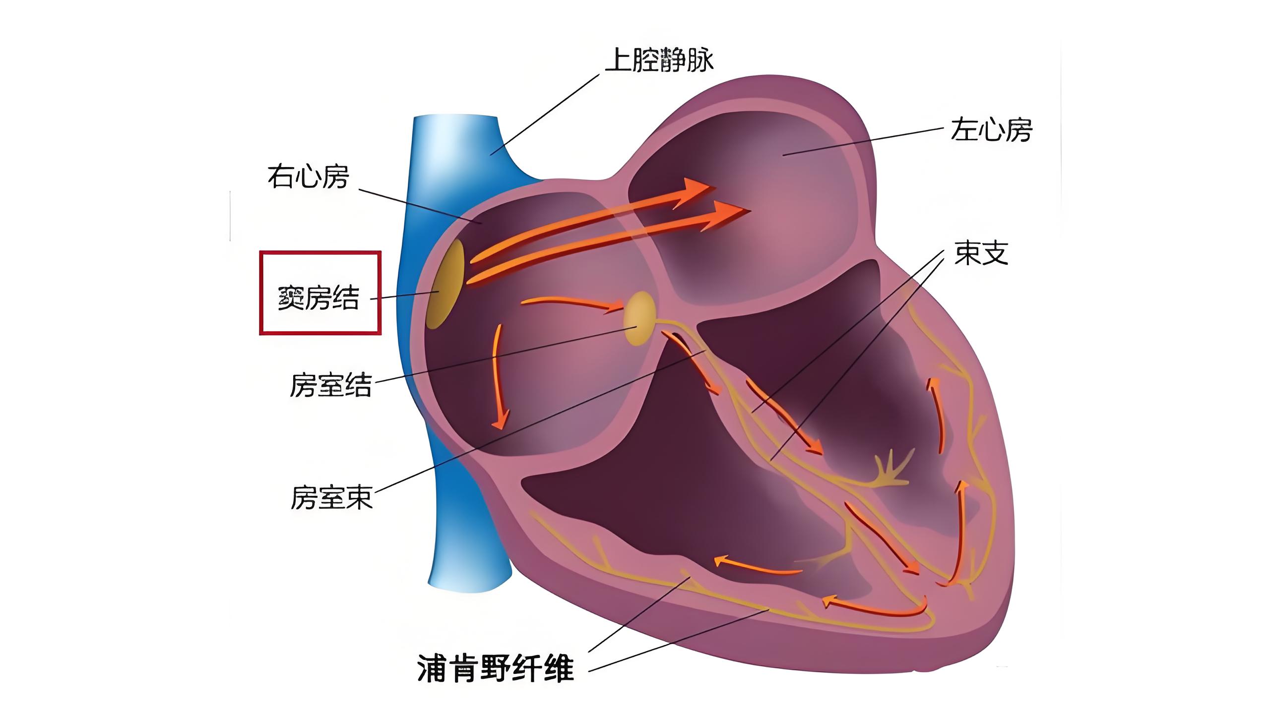 窦性心律不齐图解图片