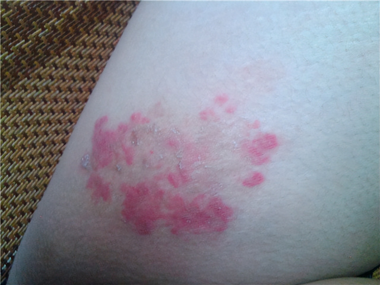 身体3个部位瘙痒,或是糖尿病信号,别以为是皮肤病