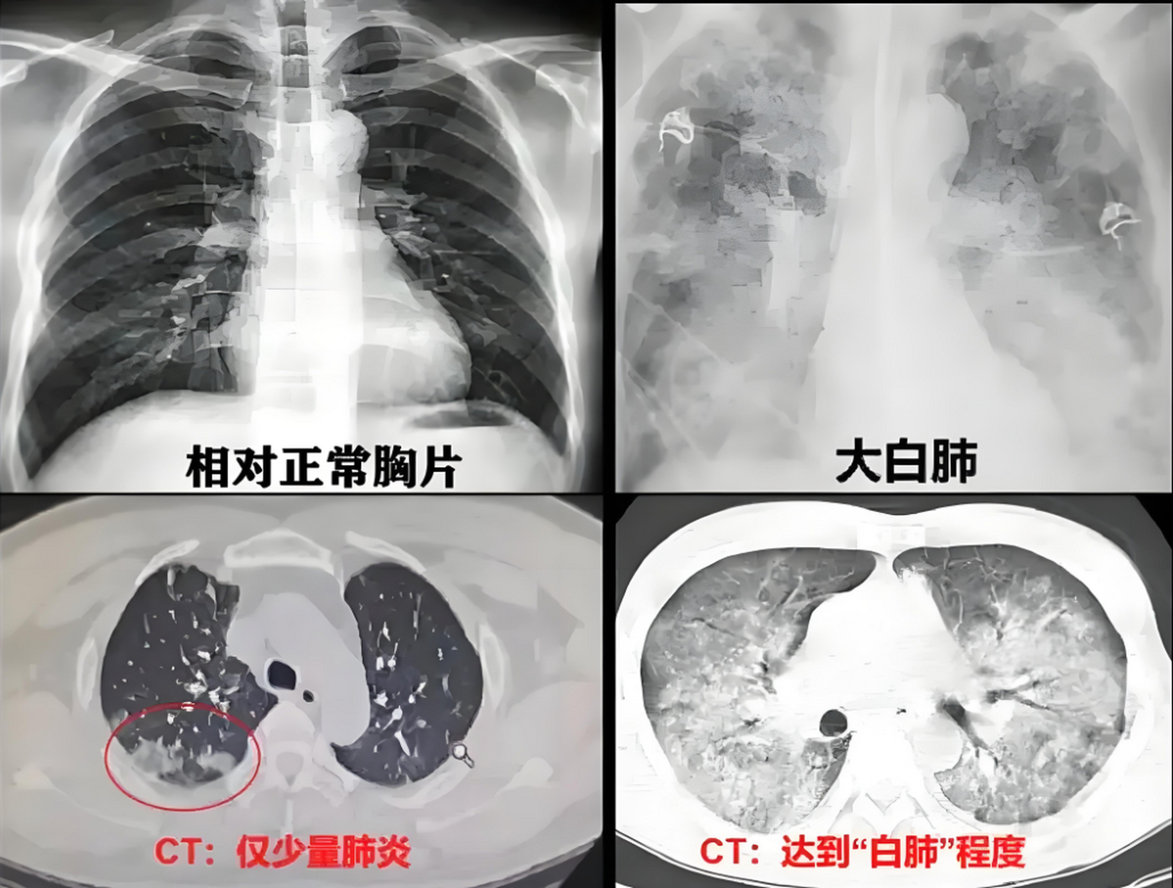 肺隔离症x线图片图片