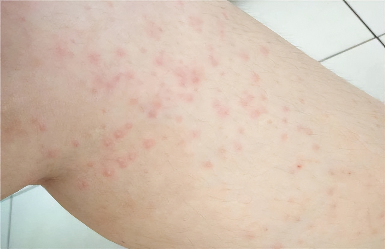 身体3个部位瘙痒,或是糖尿病信号,别以为是皮肤病