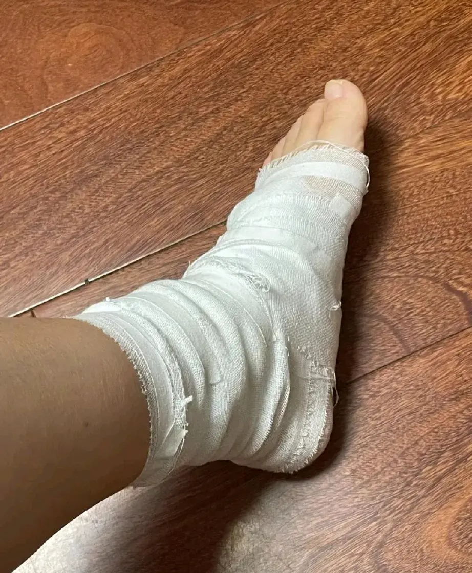 去医院检查,医生说脚扭伤了,休息十天半月就能好