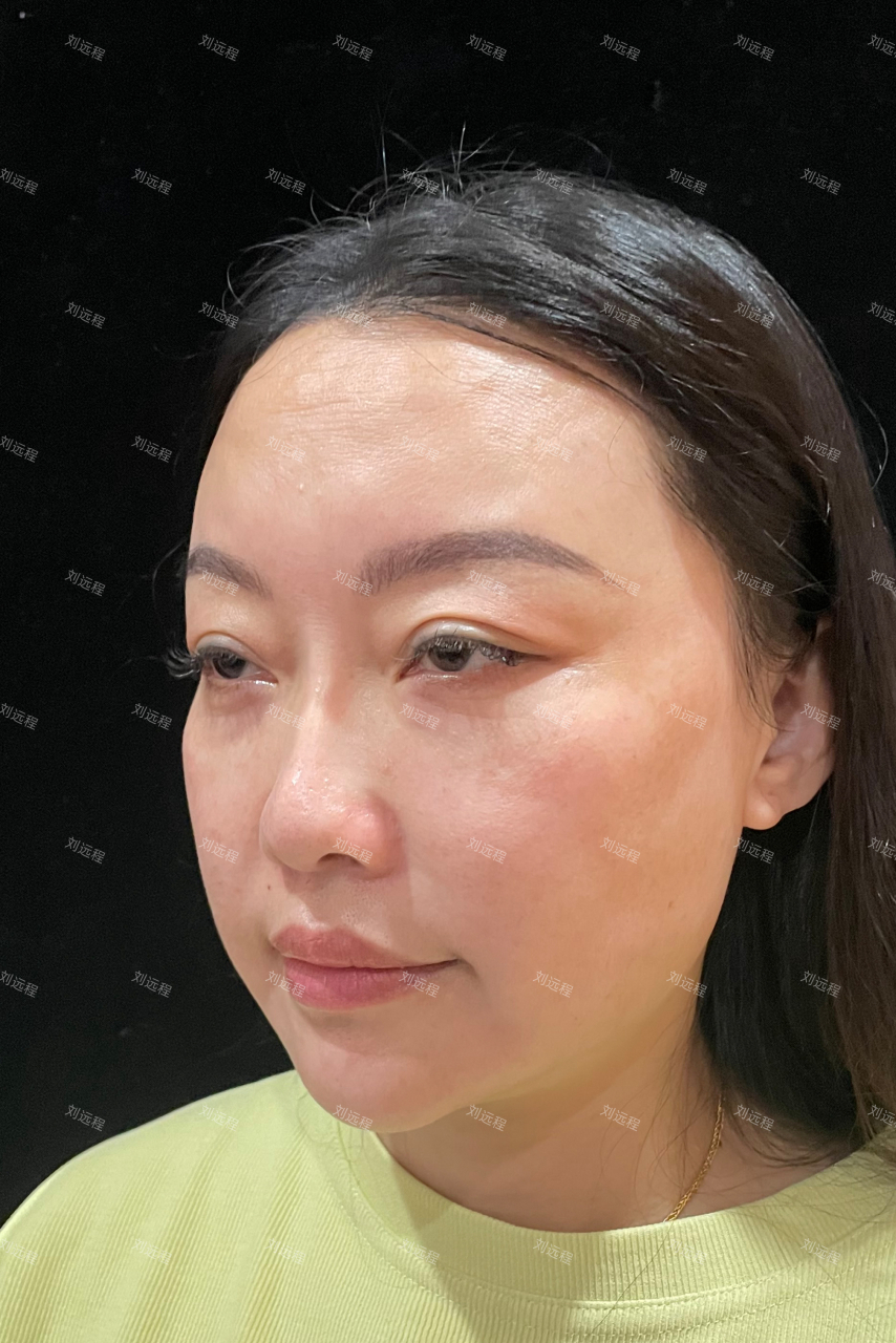 一张打过上百支玻尿酸的脸,你觉得好看吗  今天来找我的这位女士很有