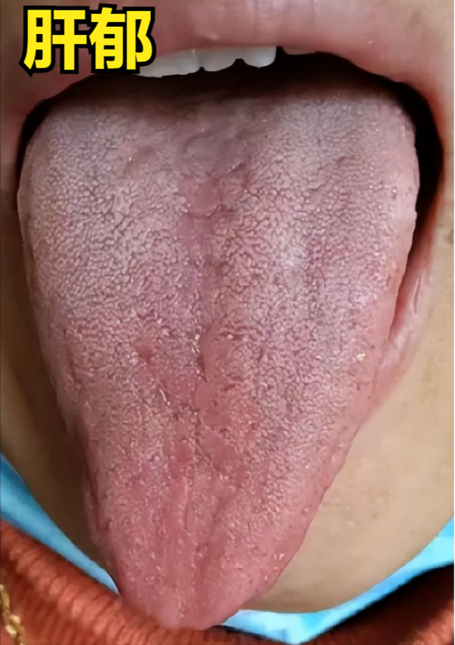 第一种,"三角舌" 这是比较典型的肝郁舌象,有这种舌头的人,就说明
