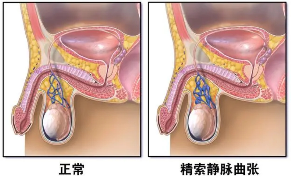 精索静脉曲张阴囊照片图片