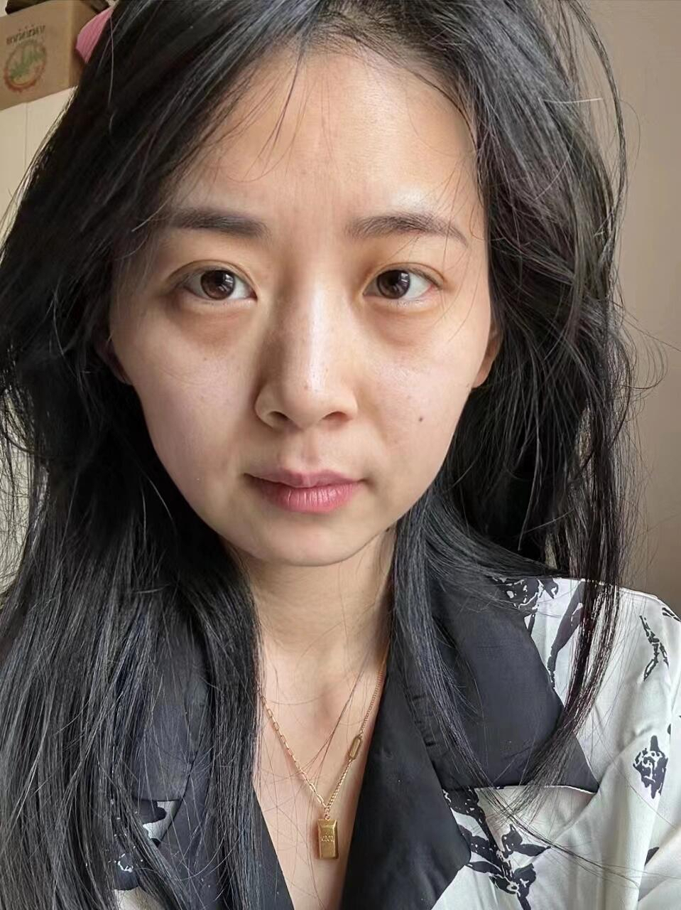 于是我背着她去成都找刘远程医生做了个提升,没想到她看到我的改变后