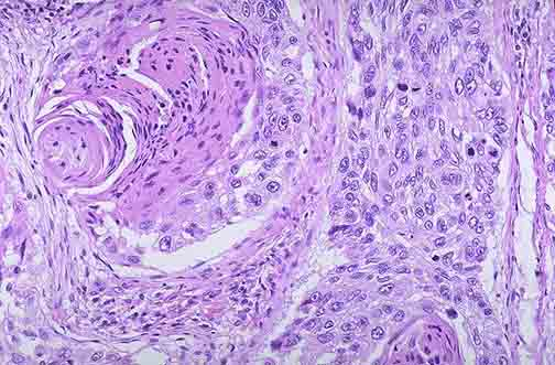 一般不推荐做基因检测,因为目前治疗相关驱动基因主要角化珠肺鳞癌