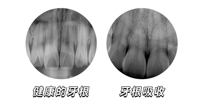 牙根吸收是什么意思图片