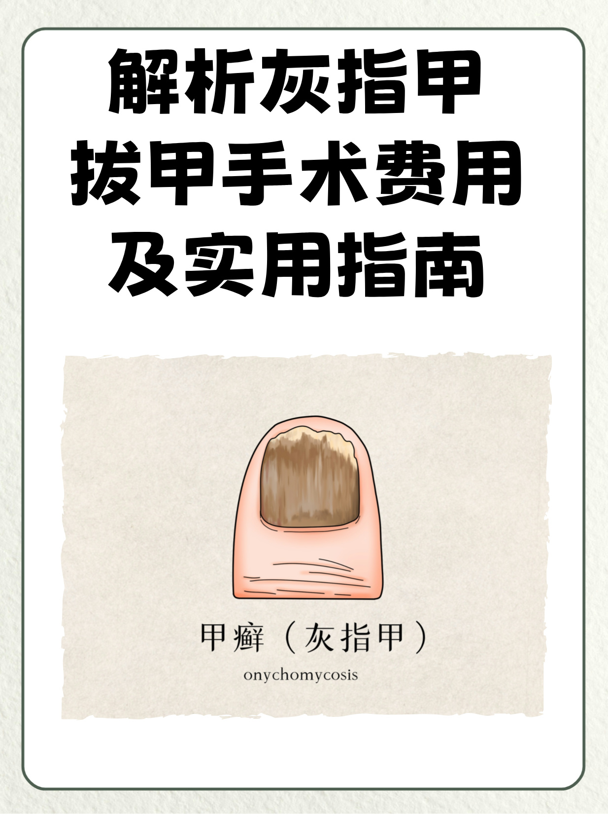 解析灰指甲拔甲手术费用及实用指南 亲爱的朋友们,今天我来给大家科普