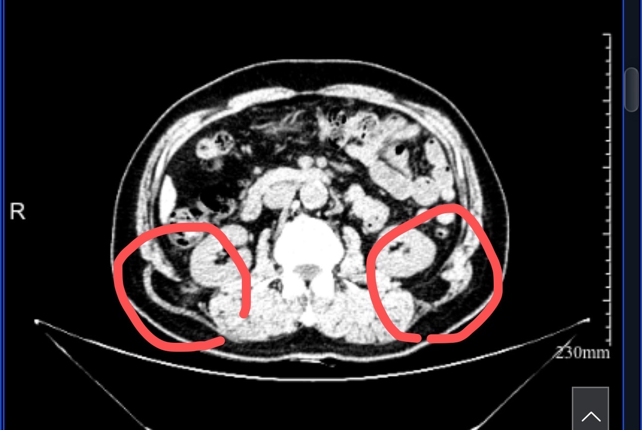 罕见双侧腰疝