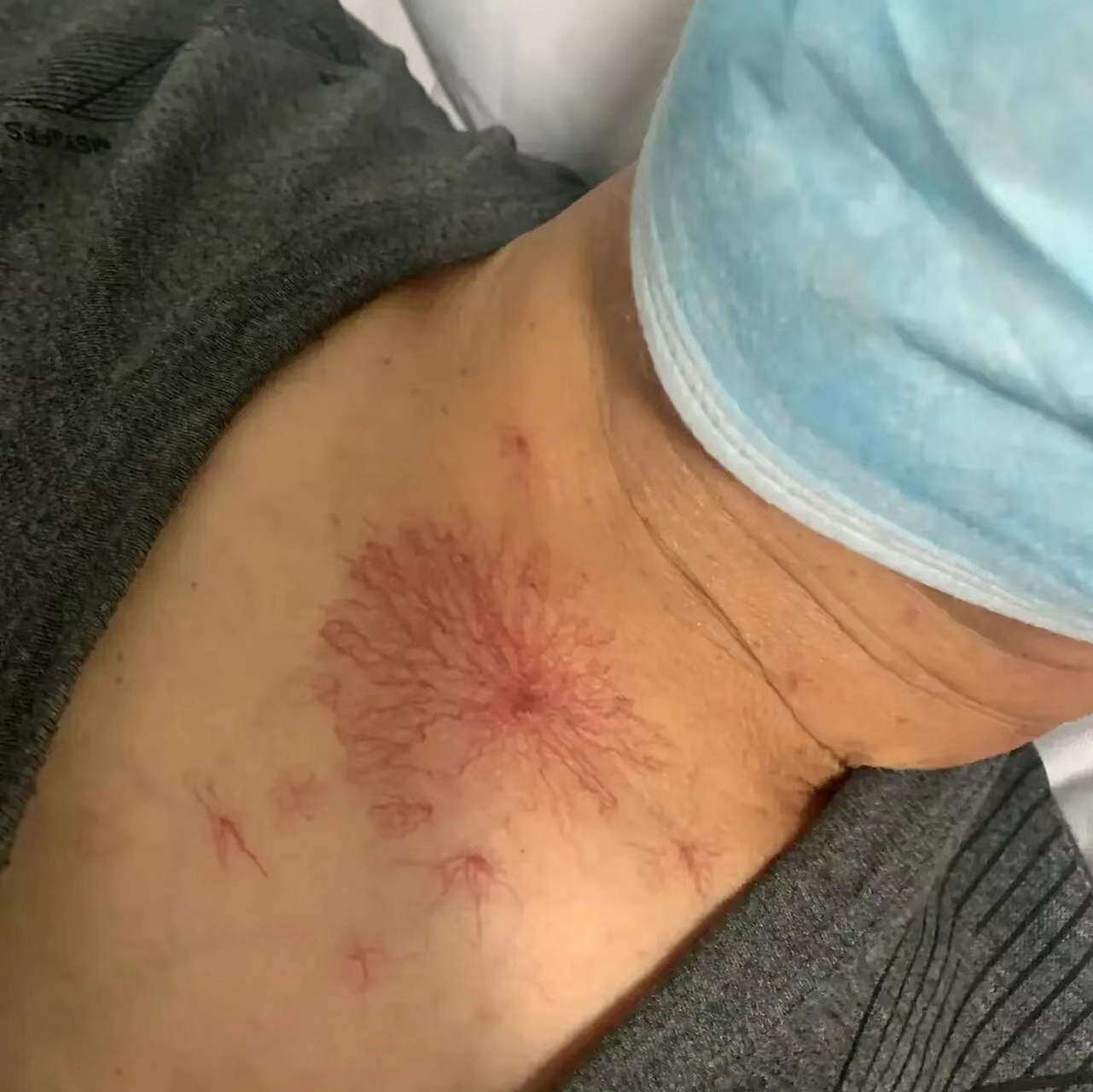 60岁河南大叔胸前惊现"蜘蛛痣",小便泛黄背后竟是.