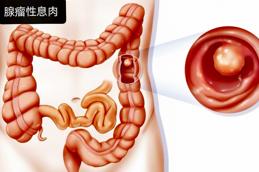 结肠癌位置图图片