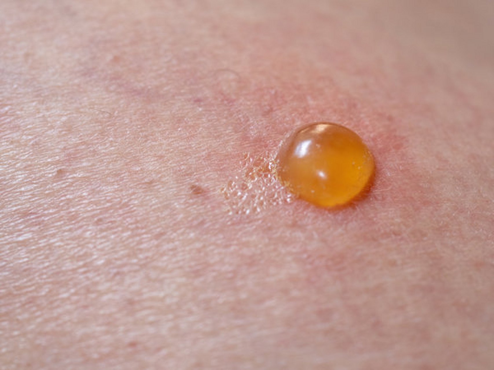 脚上突然长水泡用什么药好?