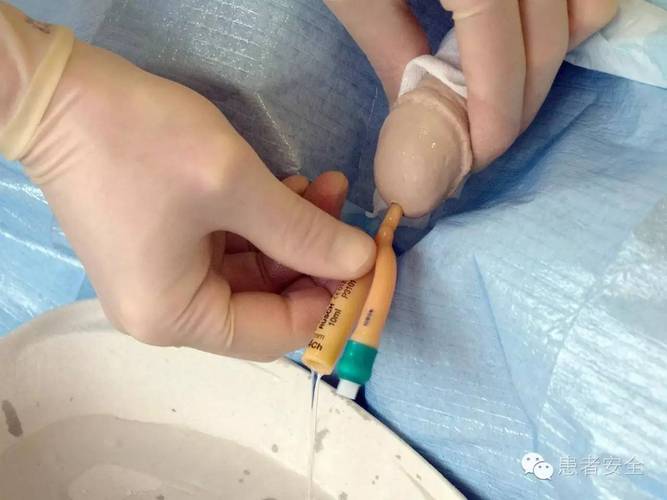 插尿管如何进行的?插完尿管对以后的生活影响吗?医生告诉你真相