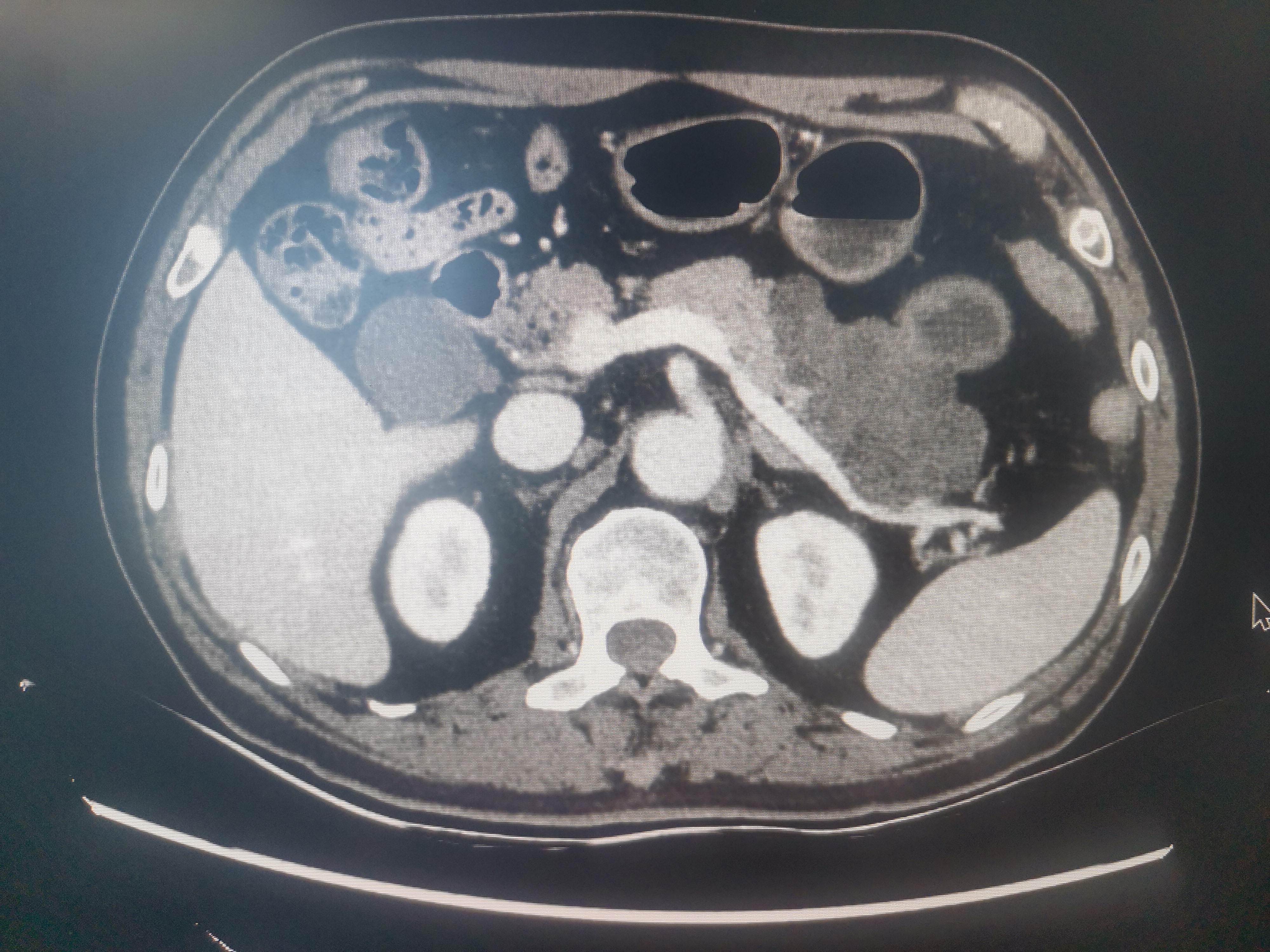 胰腺结节图片