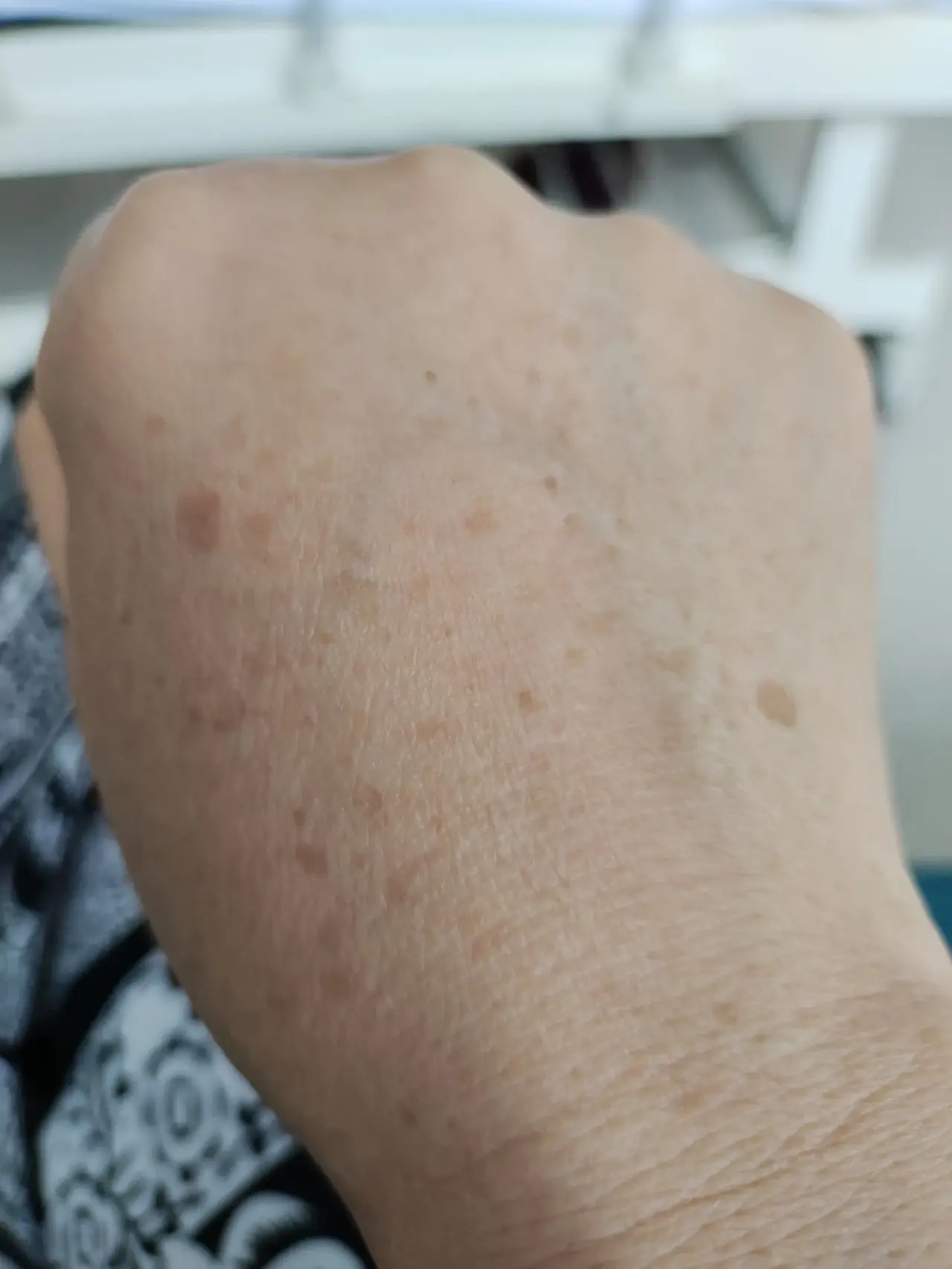 岁 不过早五六年前就开始长这种斑了 只是现在越来越多 颜色越来越重