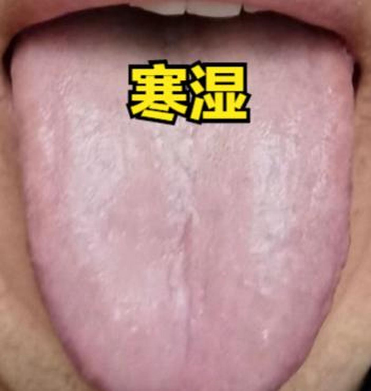 痰湿——舌边有齿痕,舌苔发白,厚腻 表现:身体困重,嗓子痰多,头脑昏沉