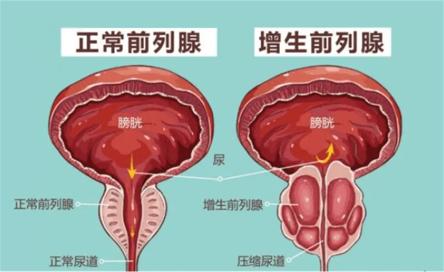 中医教你如何调理前列腺炎?