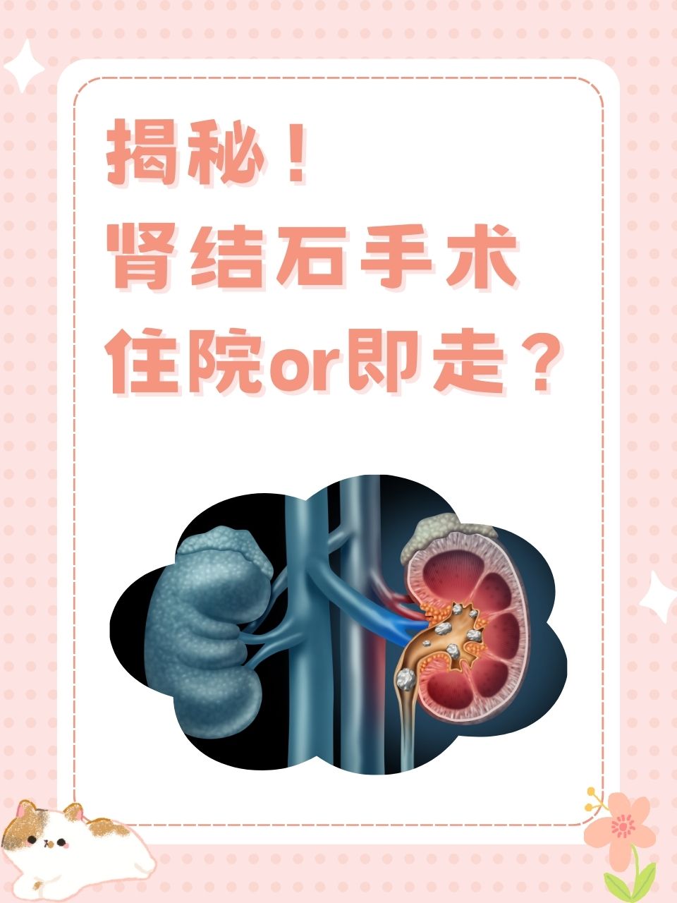 肾结石多大时需要治疗?