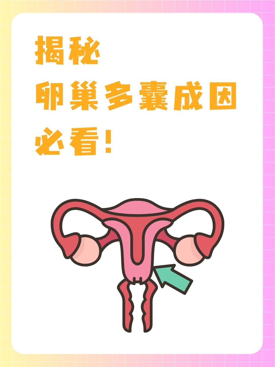 多卵巢囊是怎么回事_多卵巢囊肿是什么原因造成的,能治好吗?  第2张