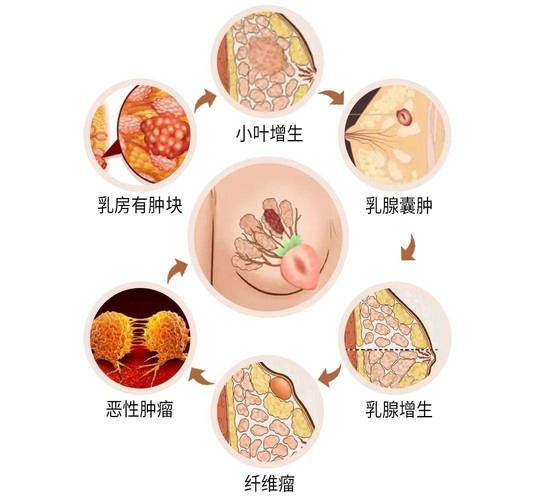 乳腺结节吃什么好 baijiahao.baidu.com