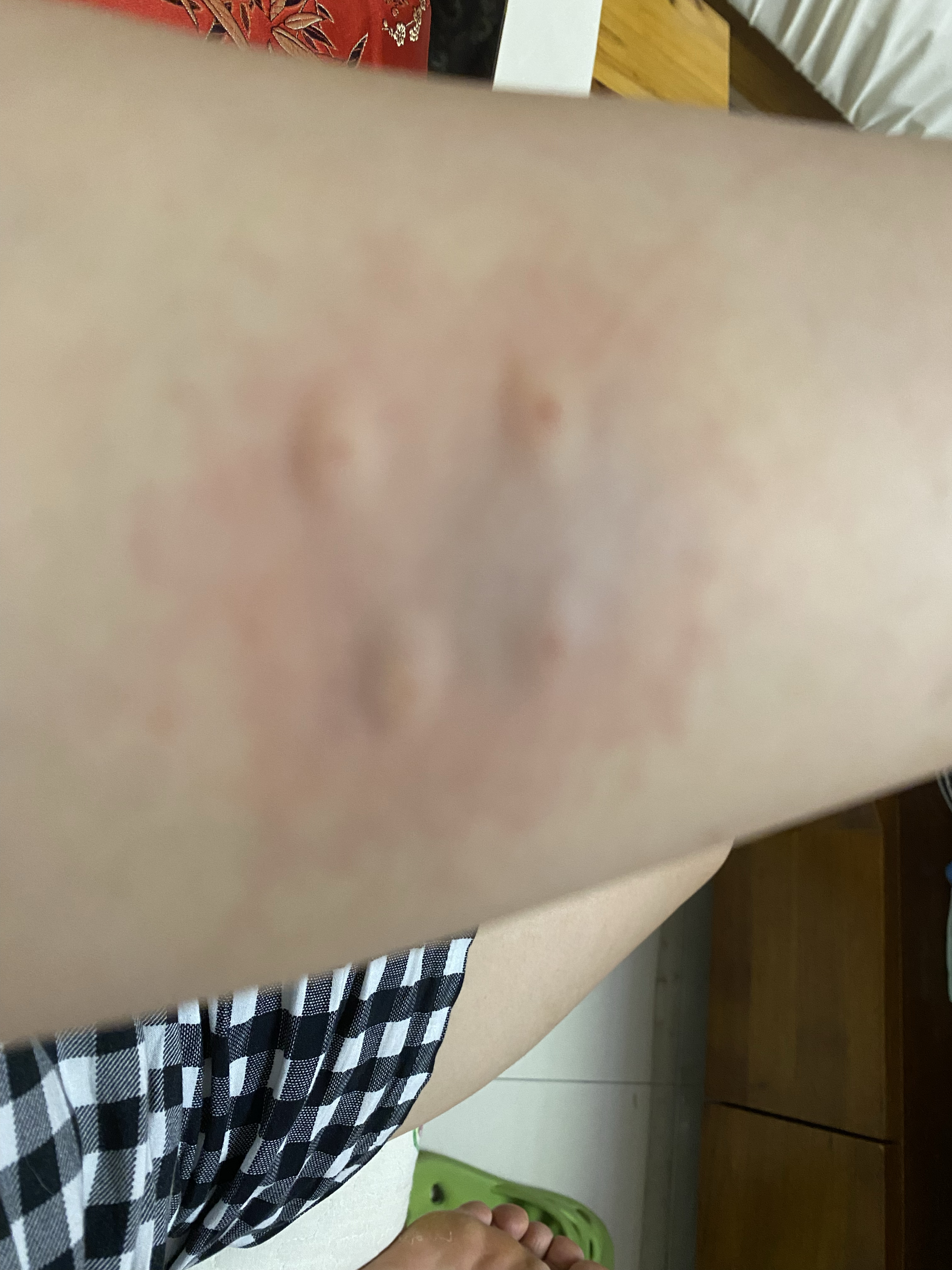 我刚给咬伤的地方涂了碘伏,但又想着要不要打疫苗呢?