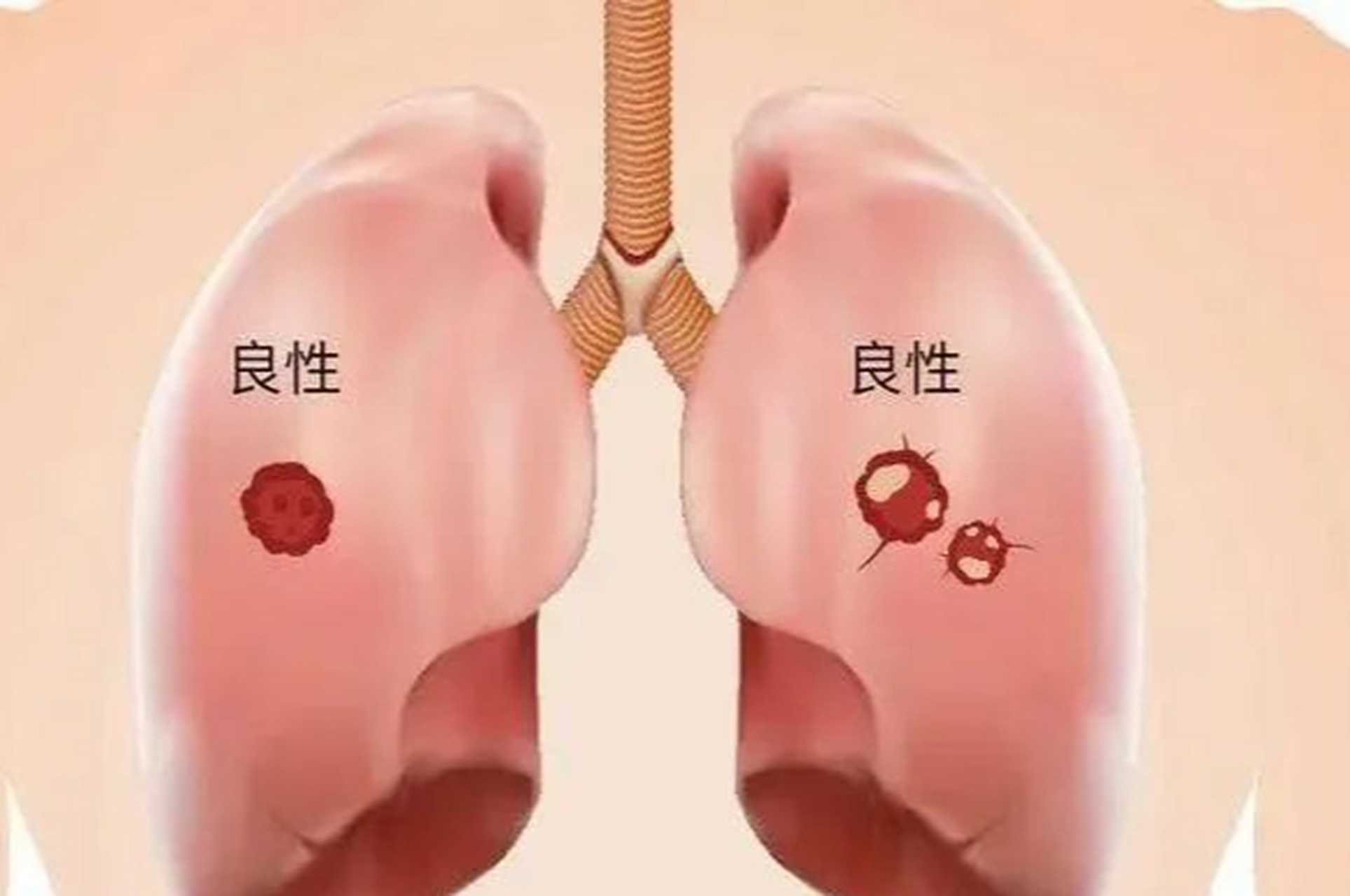 肺结节就是肺癌吗?