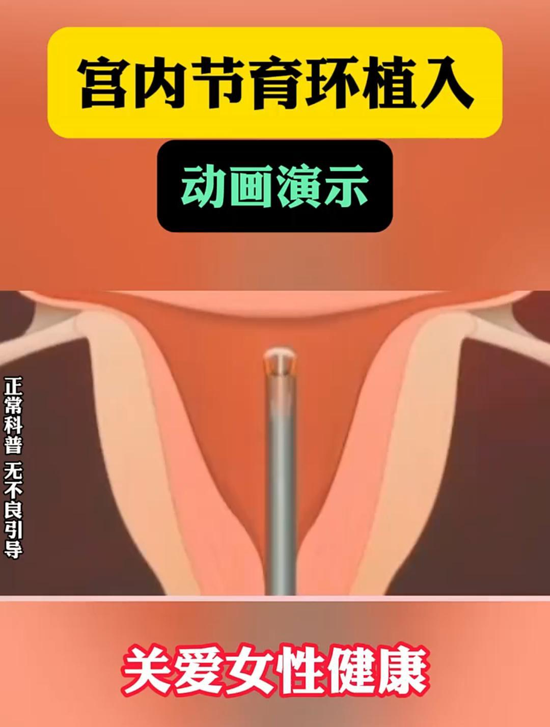 宫内节育环植入动画演示