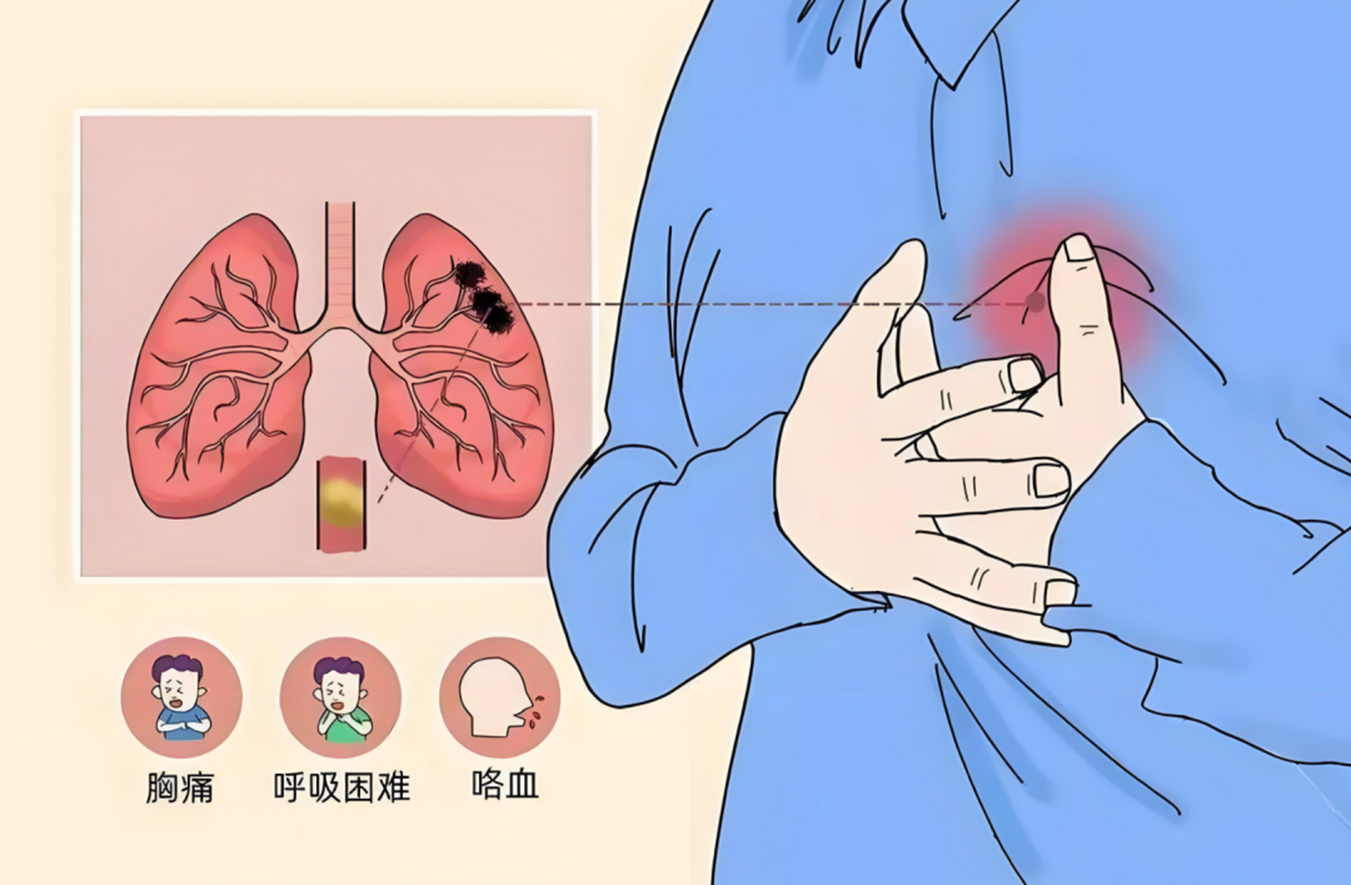 肺结节卡通图片图片