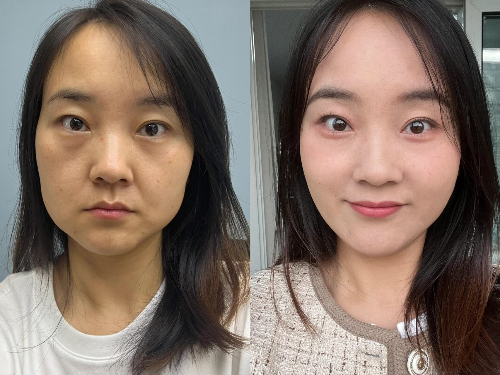 纠结了很久,跟老公商量去做面部提升,咨询的是这方面比较权威的李建