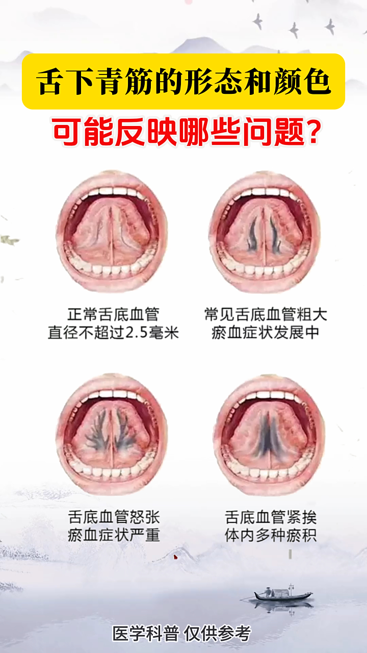 舌下青筋的形态和颜色,能看出哪些问题?