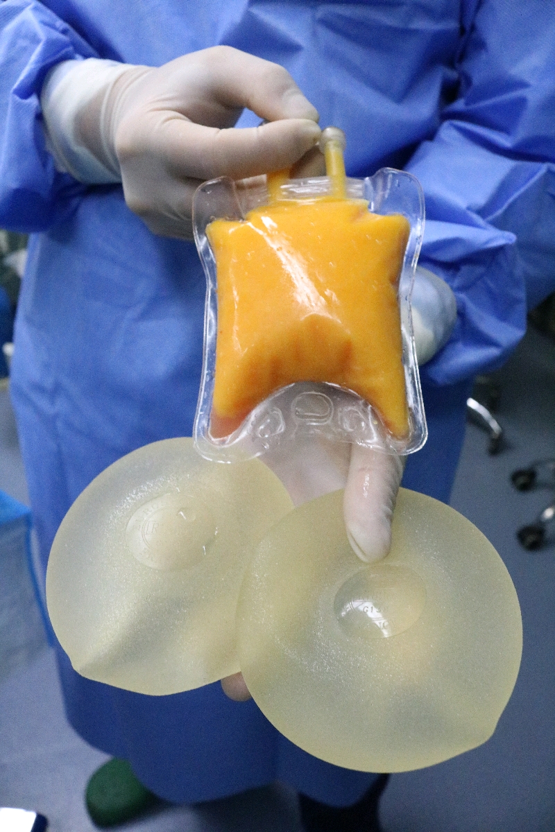 直言手感太硬了,老公嫌弃! 建议:取出假体置换脂肪!#胸部假体取出