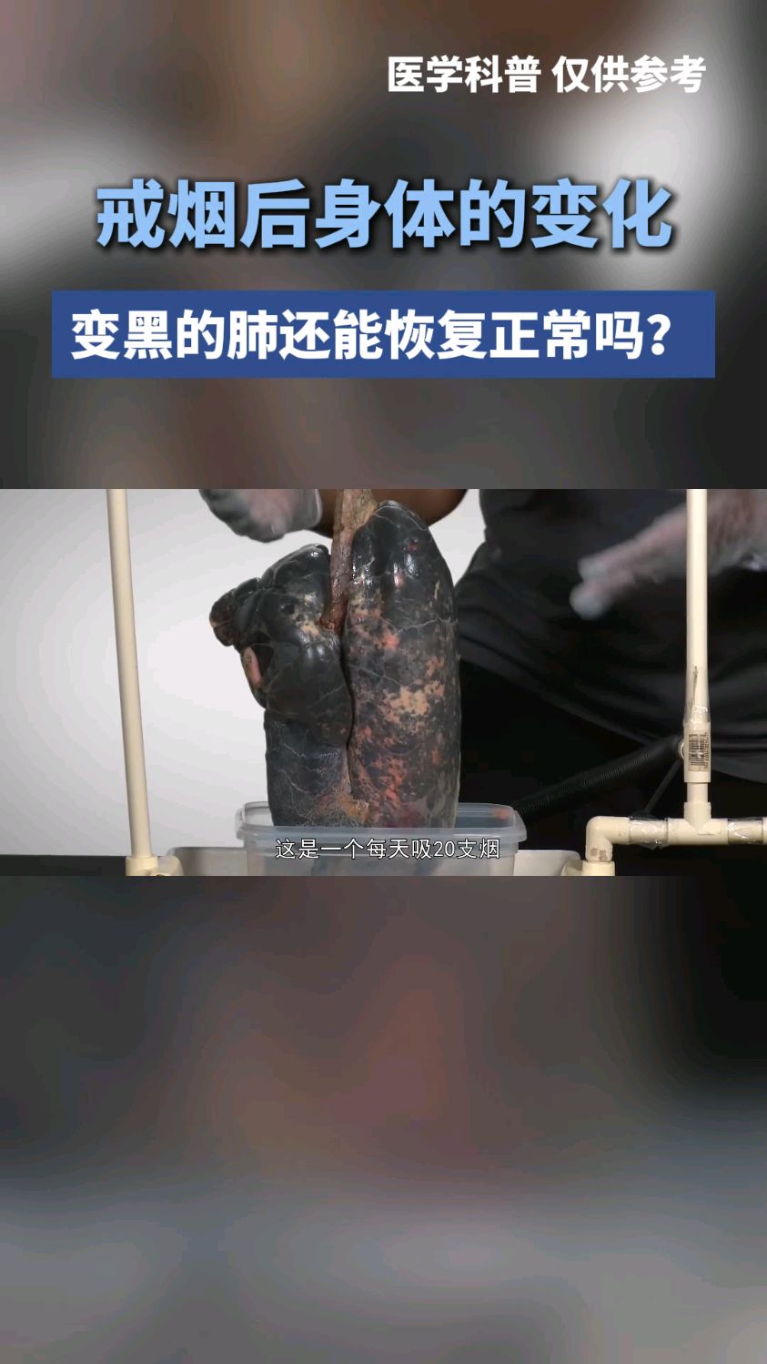 戒烟后肺真的可以恢复如初吗?