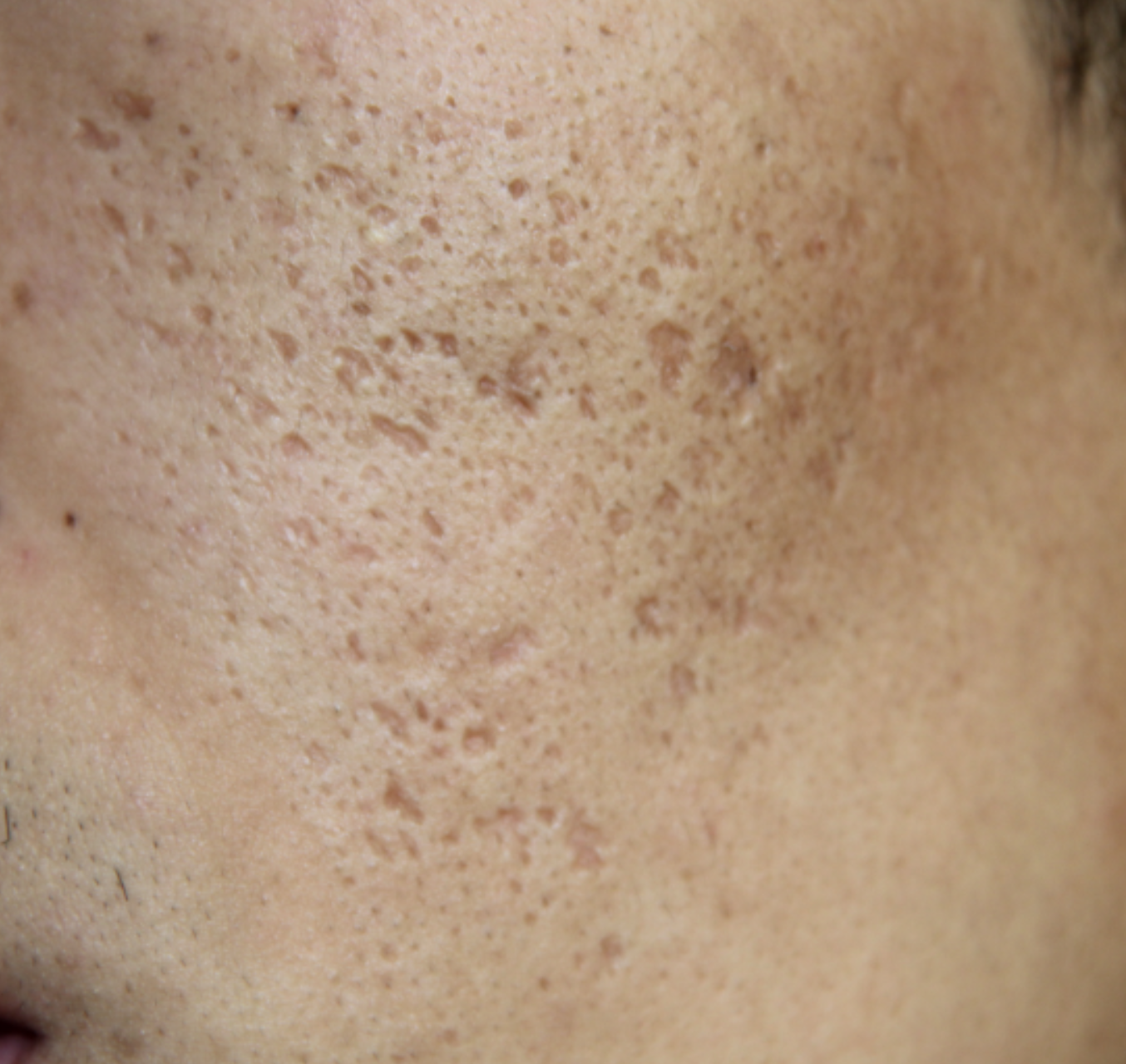 为什么不挤痘也留痘坑痘印