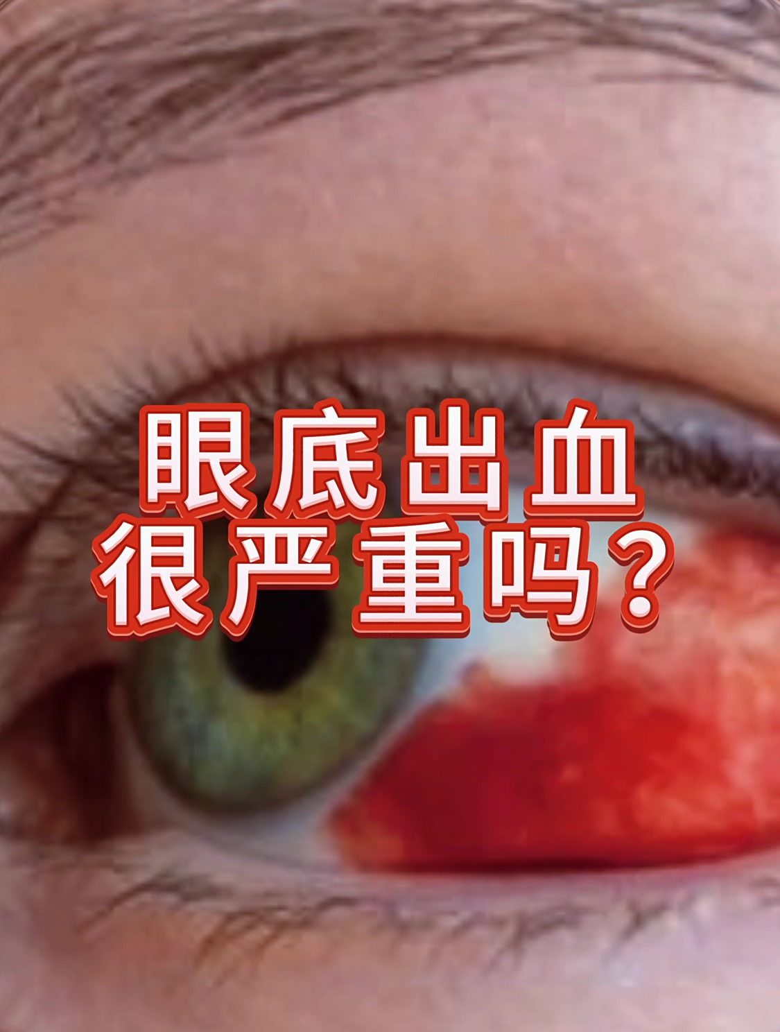 眼底出血不是小事啊 眼底出血 眼科 眼睛健康