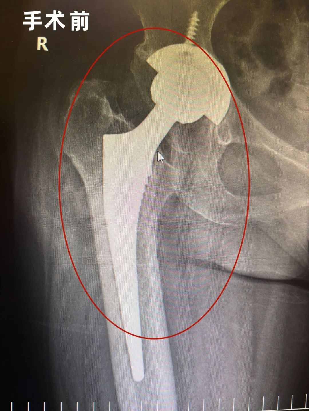 刘欢讲人工髋关节置换图片