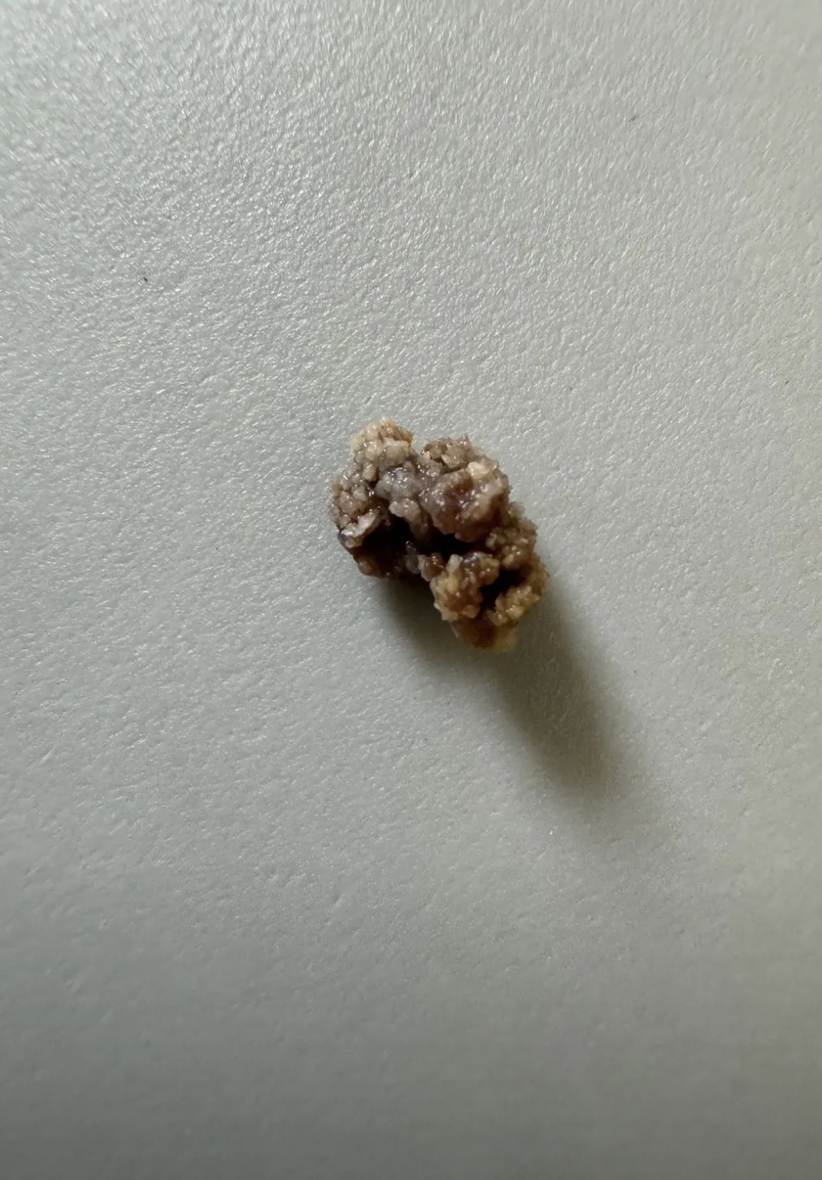 0.9cm输尿管结石排石成功