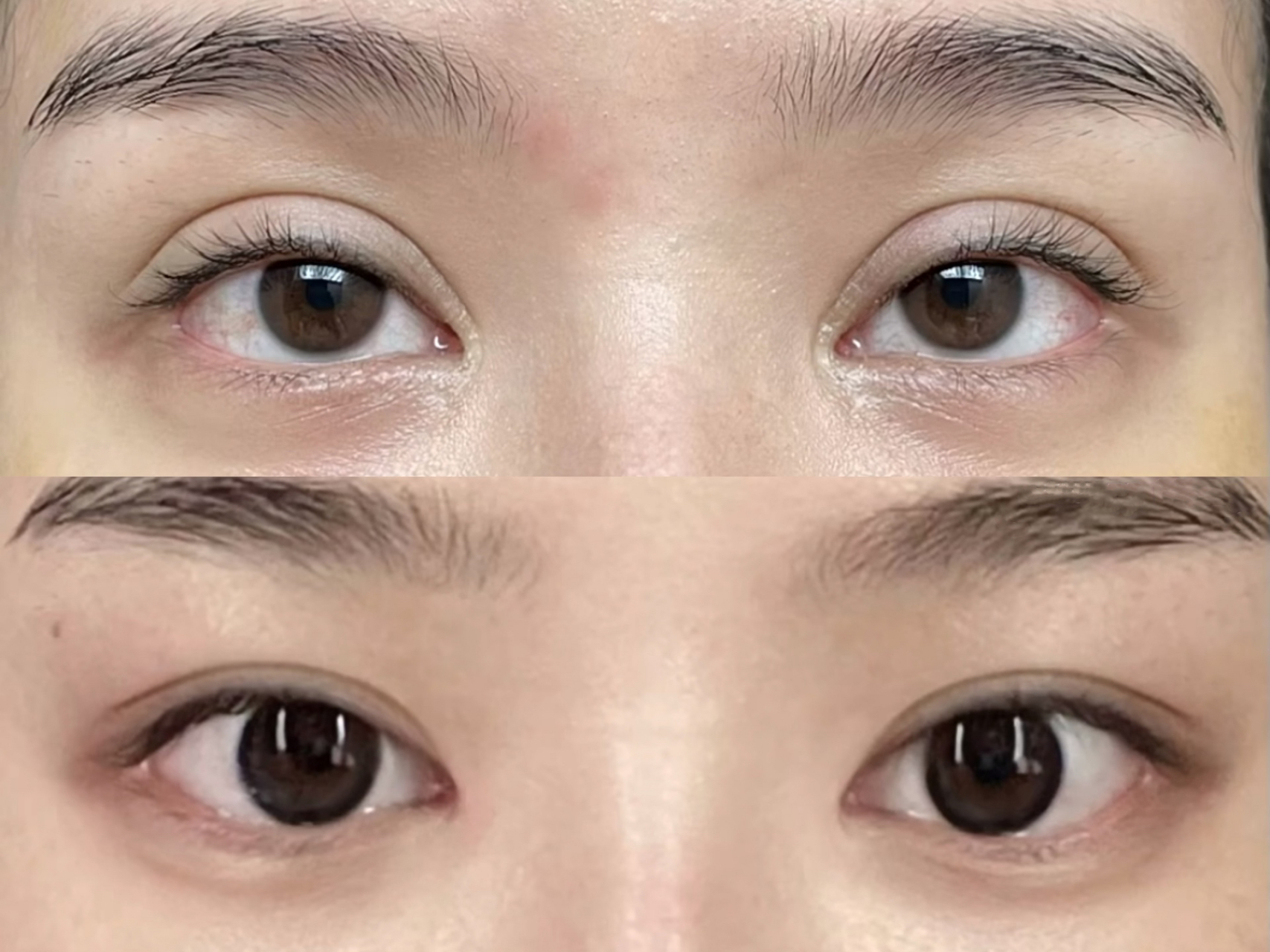方案是:双眼皮宽改窄 包眼角 提肌矫正.