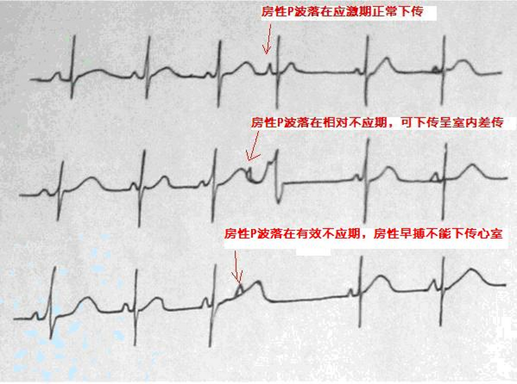 频发房性早搏图片图片