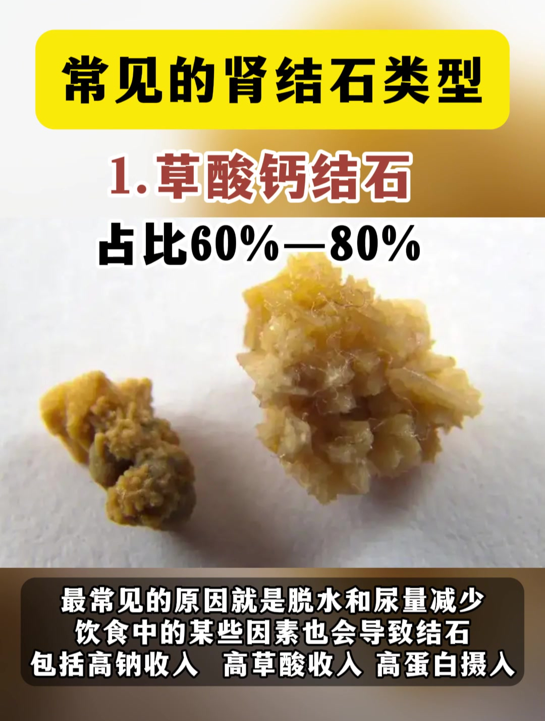 结石的种类图片