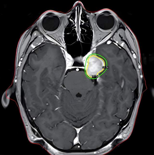 脑膜瘤3—4cm算严重的吗?