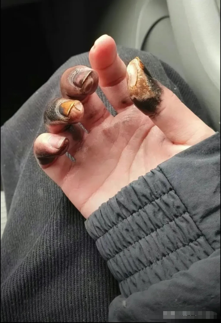 看到一位朋友发布了一张手被电打了的照片,他自己也没想到,220伏电压