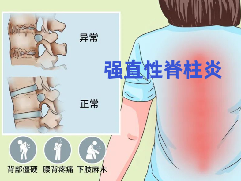 强直性脊柱炎会遗传吗图片