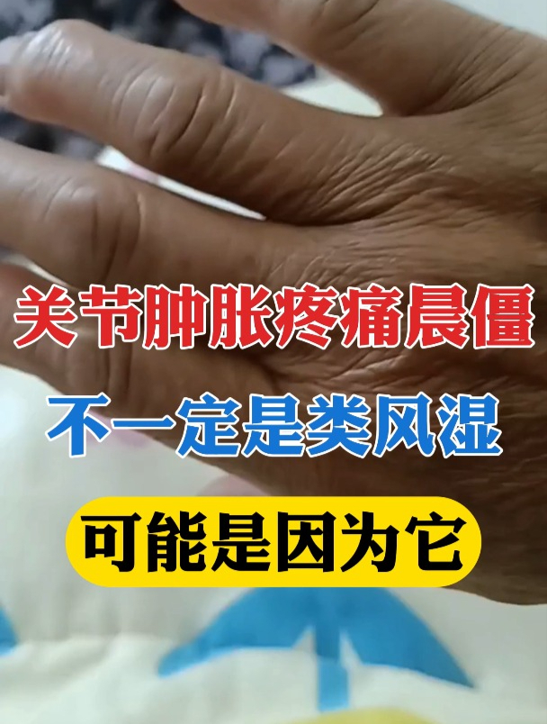 关节肿胀疼痛晨僵,不一定是类风湿,可能是因为它