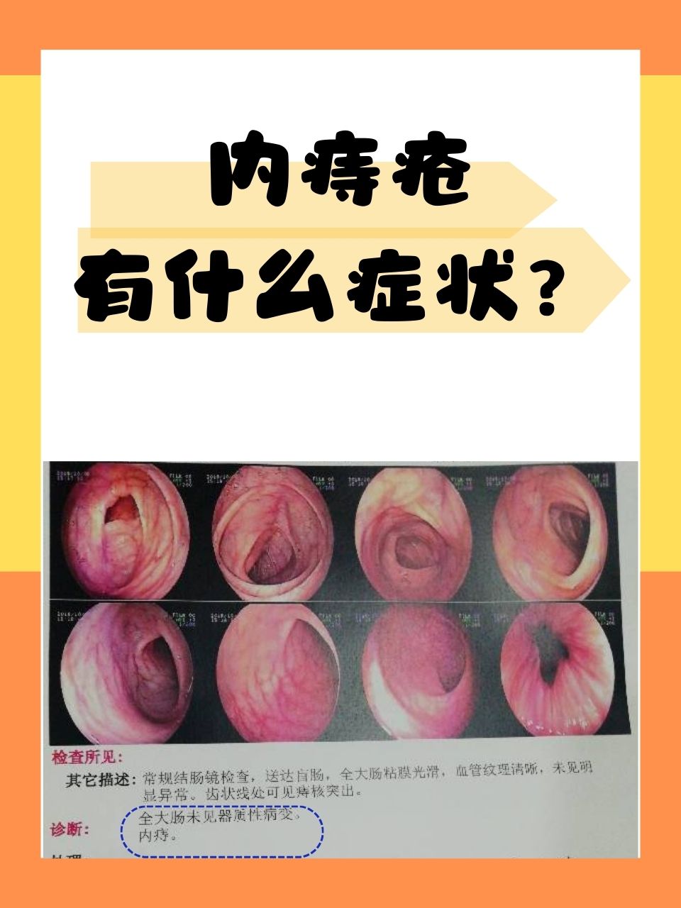 内痔疮女性症状图片