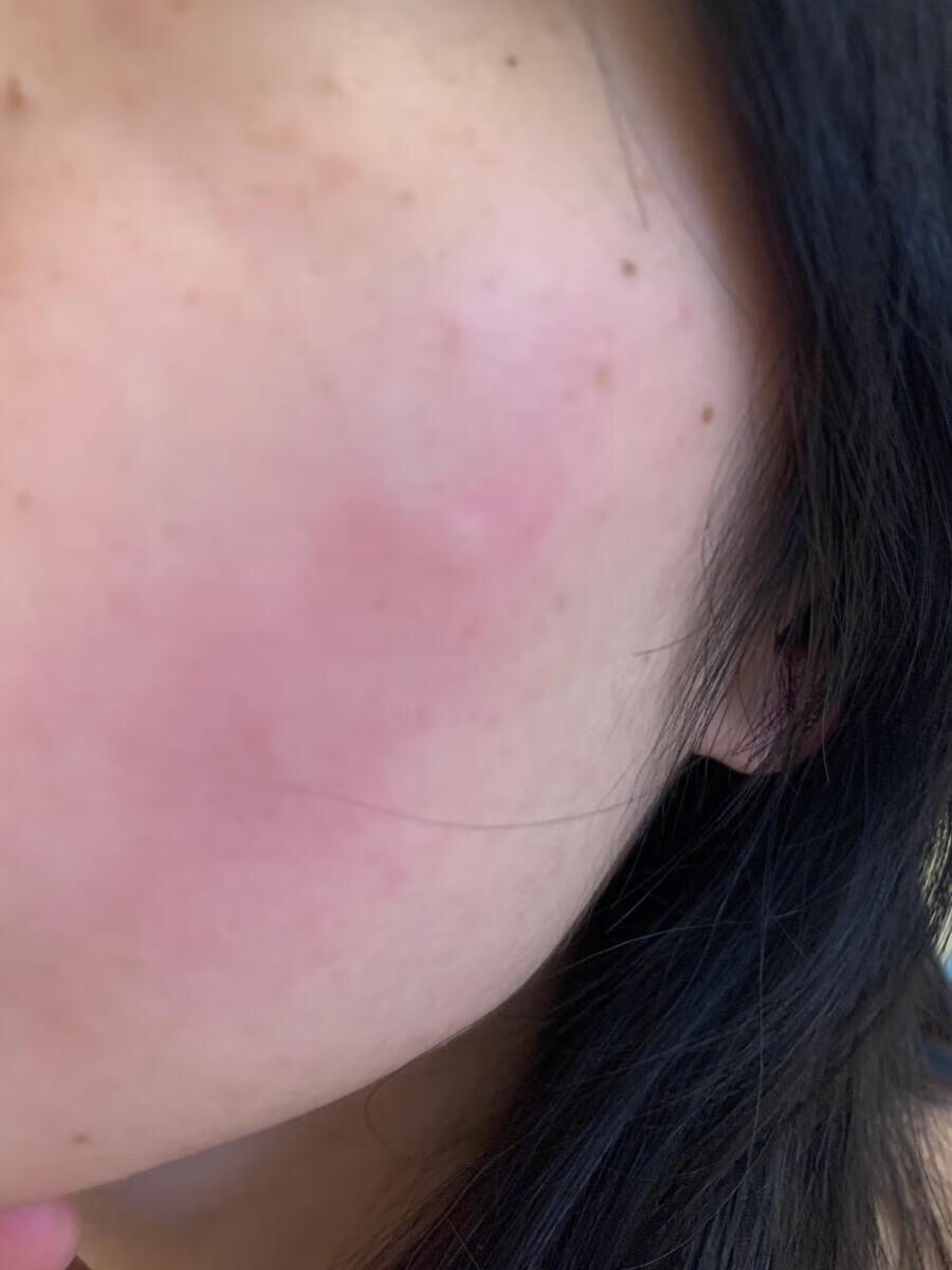 面部红红的,是过敏吗?