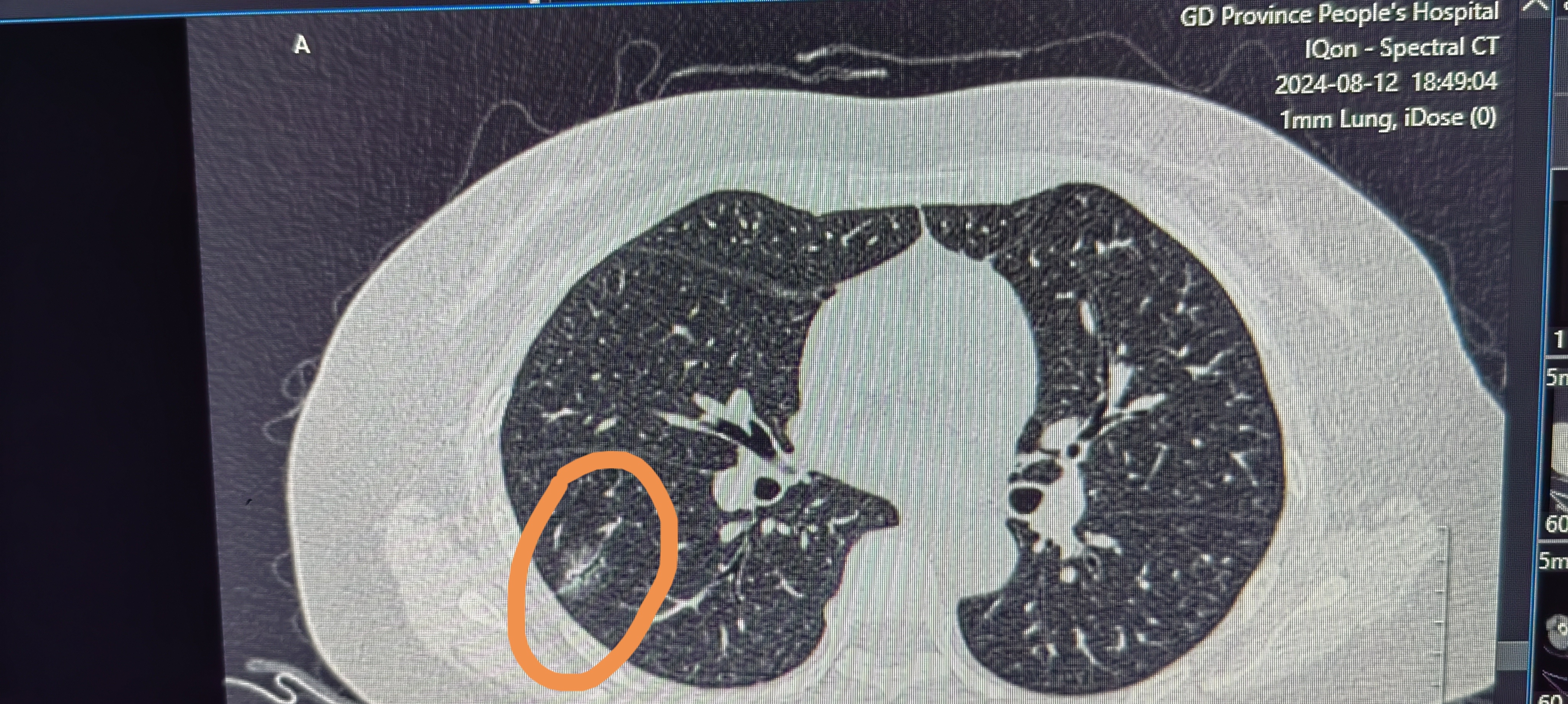 肺磨玻璃结节术前ct影像