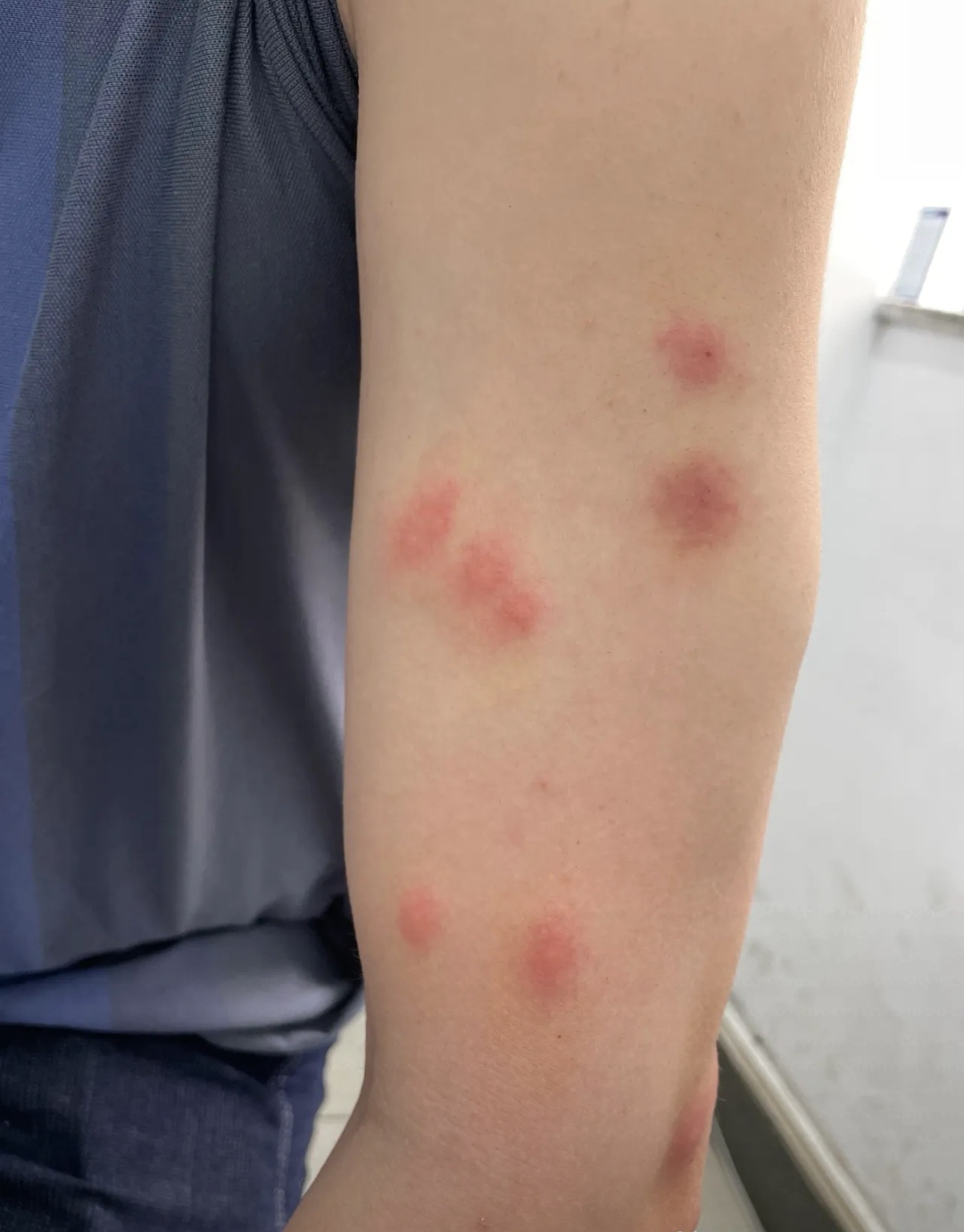 一支不含激素的口服液可以用于很多种瘙痒性皮肤问题