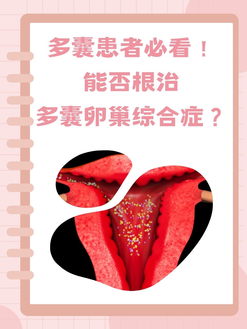 得卵巢多囊的原因_得卵巢多囊的原因是什么