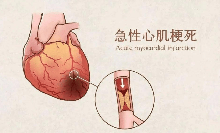 心梗的诱因图片