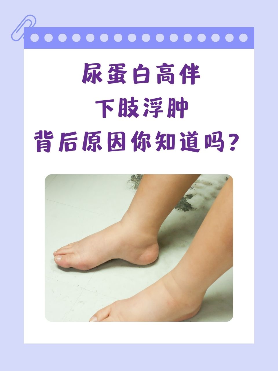 尿蛋白高伴下肢浮肿,背后原因你知道吗?